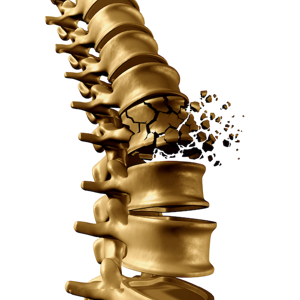Spinal,Fracture,And,Traumatic,Vertebral,Injury,Medical,Concept,As,A