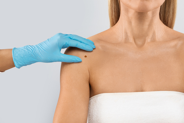 Doctor hand checking mole nevus on unrecognizable woman’s shoulder